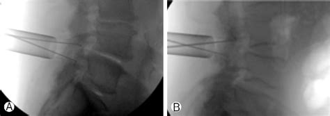 Intraoperative Fluoroscopic Images Showing The Position Of The