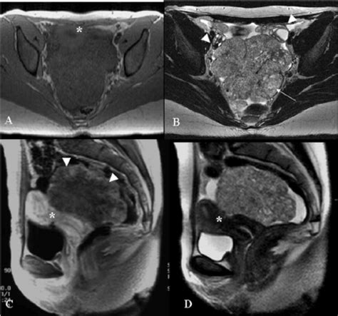 Pelvic Mr Exam Axial Gre T1 Weighted A Axial Tse 512 T2 Weighted Download Scientific