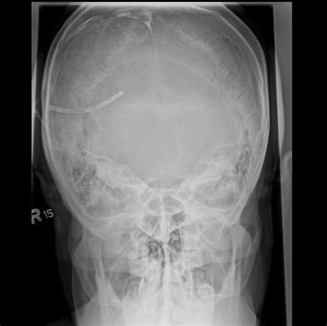 Radiography IV AP Axial Towne Grashey Diagram Quizlet