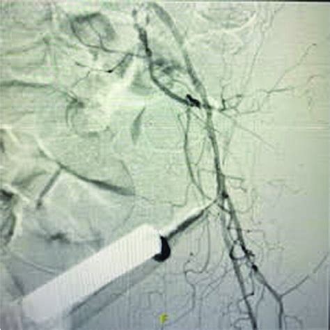 selective left sided iliac angiogram note  small entire external