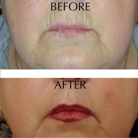 Botox On Smokers Lines Before And After Photos 11 Facial Injections