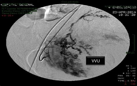 Selective Embolisation Of The Right Uterine Artery Vvu Right Bladder