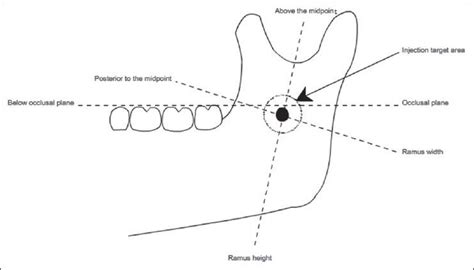 Inferior Alveolar Block Injection