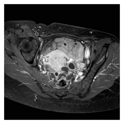 Computed Tomography Scan Abdomen And Pelvis Showing Recurrent Benign