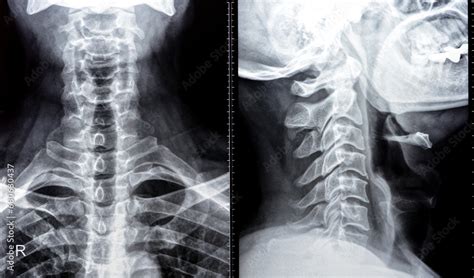 Plain X Ray Of Cervical Spine Revealed Straightened Cervical Curve