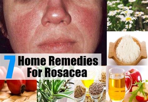 7 Home Remedies For Rosacea Home Remedies For Rosacea Rosacea Natural Remedies For Rosacea