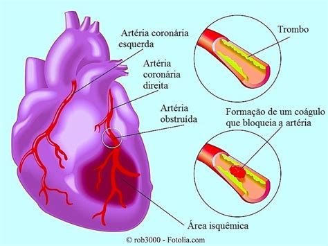 O Infarto Agudo Do Miocárdio é Definido Como Uma Obstrução