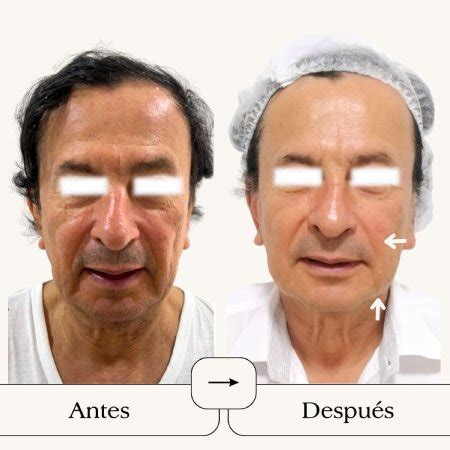 Antes Y Despu S Rejuvenecimiento Facial De Vivante Medicina Est Tica