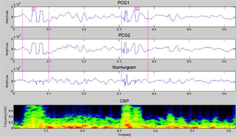 Mitral Regurgitation In A 5 Year Old Patient The Murmurgram Shows A