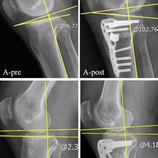 Posterior Tibial Slope PTS Was Increased After High Tibial Osteotomy