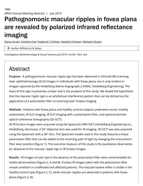 Pdf Pathognomonic Macular Ripples In Fovea Plana Are Revealed By