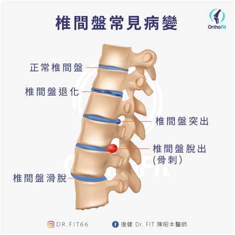 腰椎椎間盤prp注射， 椎間盤突出有解方 Orthofit陳昭本醫師