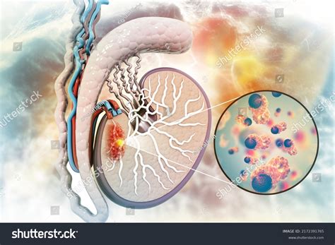 Testicular Cancer Cross Section 3d Illustration Stock Illustration