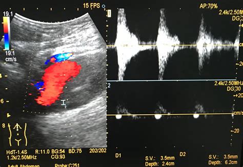 Vietnamese Medic Ultrasound Case 490 Anechoic Crescent S Sign Of