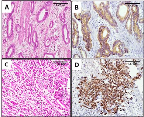 A B Hande Of Well Differentiated Adenocarcinoma And Corresponding Ihc