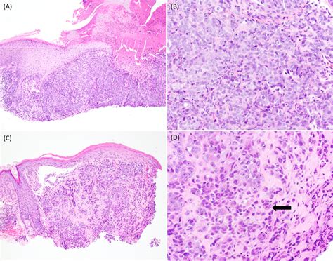 Primary Cutaneous SMARCA4 Deficient Undifferentiated Malignant Neoplasm