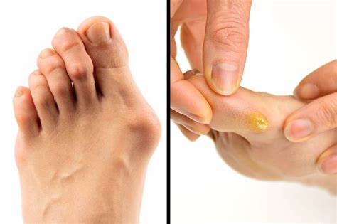 Corn Vs Bunion On Foot Deals Emergencydentistry