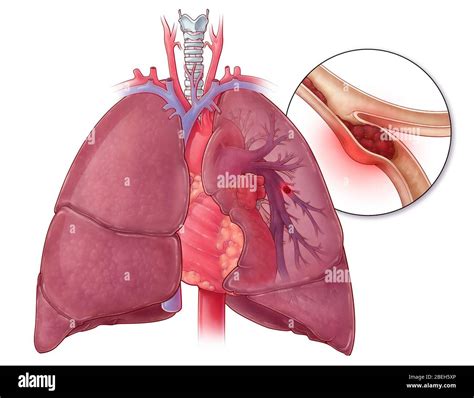 Trombosis Pulmonar Tromboembolismo Pulmonar Y Embolia Paradojica