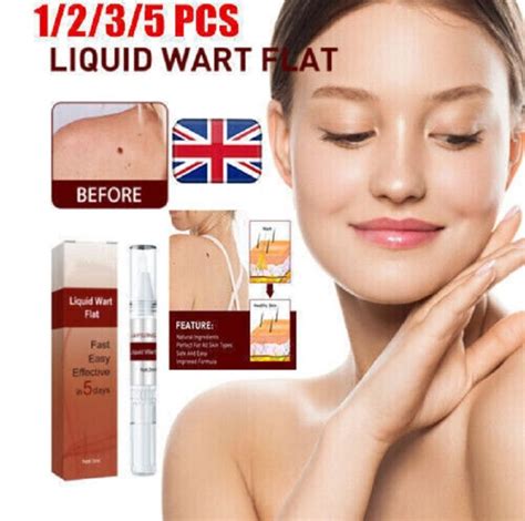 Non-Invasive Skin Tag Removal Best Skin Tag Removal Products Quick And ...