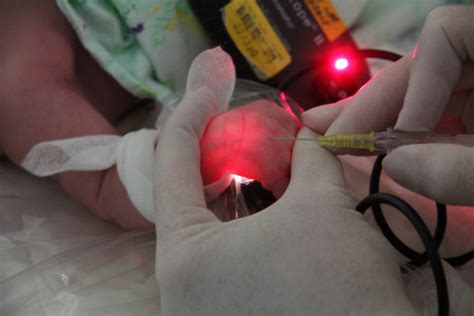 Peripheral Intravenous IV Catheter Insertion For Neonates Safer