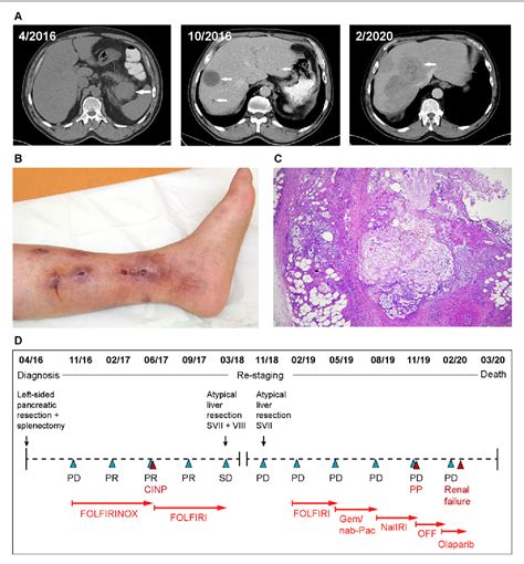 Figure 1 From Pancreatic Acinar Cell Carcinoma With Germline Brca2 Mutation And Severe