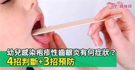 幼兒感染疱疹性齒齦炎有何症狀？4招判斷3招預防 Mamibuy媽咪拜 Line Today