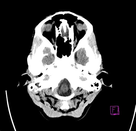 CT head interpretation