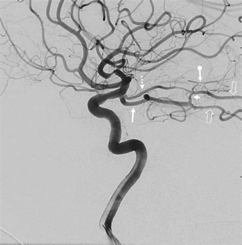 Anterior Choroidal Artery | neuroangio.org