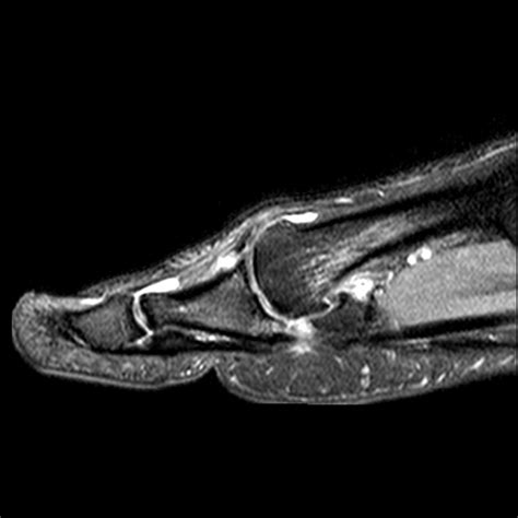 Turf Toe Image Radiopaedia Org