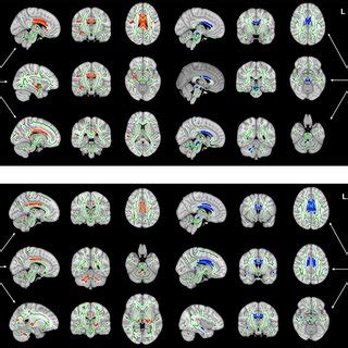 Brain White Matter Wm Microstructural Changes In Eg Patients Compared