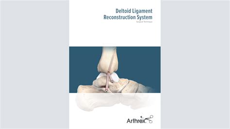 Arthrex - Deltoid Ligament Reconstruction