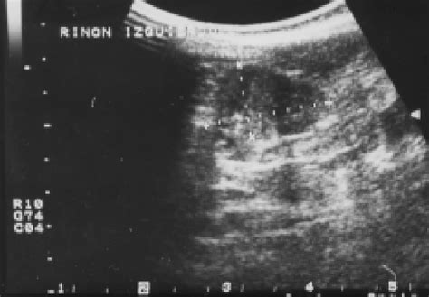 Figure 3 From Anterior Urethral Valves Endoscopic Fulguration Single