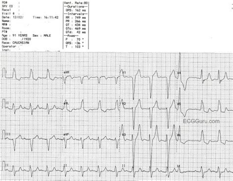 Aortic stenosis | ECG Guru - Instructor Resources