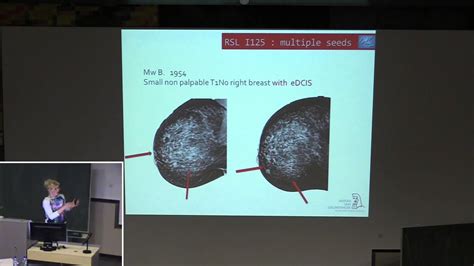 Use Of Iodine Seeds As Guidance Method During A Neoadjuvant Treatment