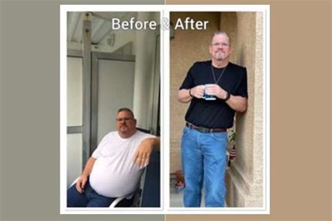 Franks Story Gastric Sleeve Ucla Health