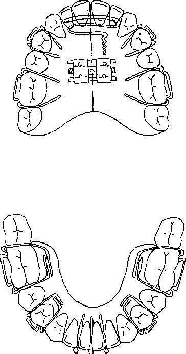 Figure 3 From The Modified Twin Block Appliance In The Treatment Of Class Ii Division 2