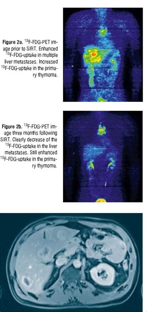 Figure From Treatment Monitoring With F Fdg Pet In Metastatic