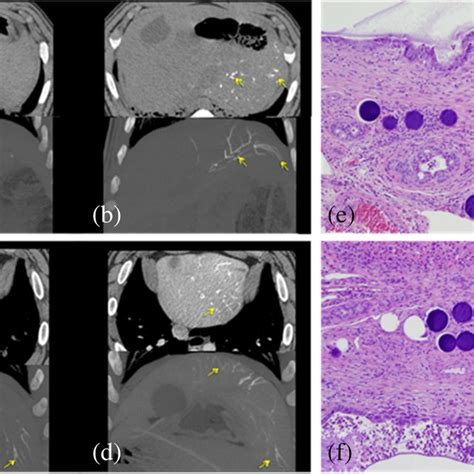 Multi Detector Computed Tomography Mdct Top And Maximum Intensity Download Scientific