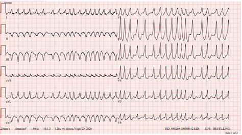 Wolff Parkinson Whites Syndrom Hos Midaldrende Mand Med Permanent