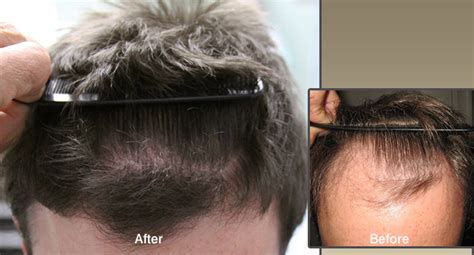 Hair Restoration In La Jolla Ca Dr Timothy Carman