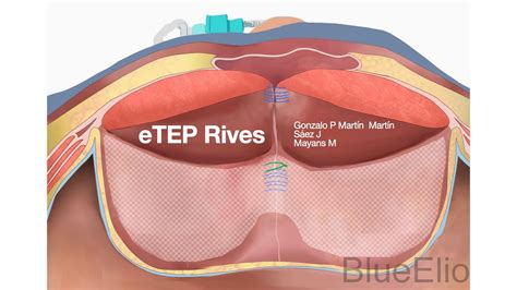 Etep Rives Cirug A M Nimamente Invasiva De Hernia Incisional O