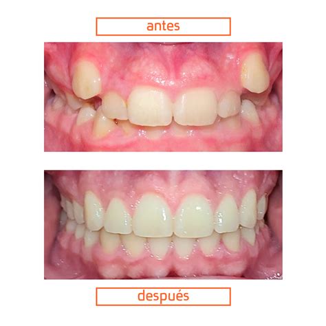 Cómo saber si te tienen que poner brackets Razones