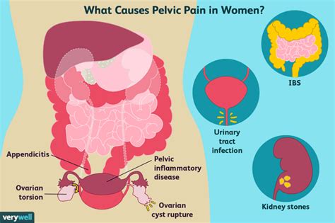 Causes De La Douleur Pelvienne Chez Les Femmes Et Les Hommes Fmedic