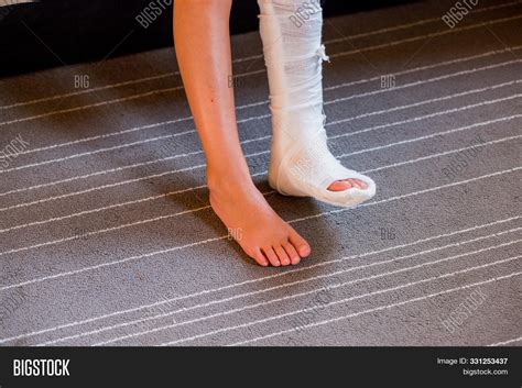 Broken Leg Cast Little Image & Photo (Free Trial) | Bigstock