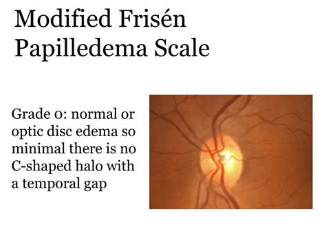 PPT - Idiopathic Intracranial Hypertension Treatment Trial Modified Frisén Scale for Grading ...