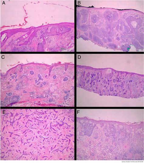 Basal Cell Carcinoma Vs Squamous Cell Carcinoma Histology