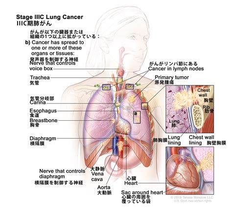 がん情報サイト｜pdq®日本語版患者様向け