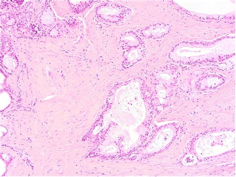 Sclerosing Polycystic Adenosis Of The Oral Cavity British Journal Of