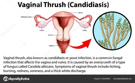 Vaginal Thrush Candidiasis Infographic With Explanation Illustration