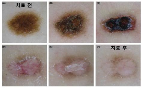 색소성 피부질환 레이저 치료 개선된 효과 입증